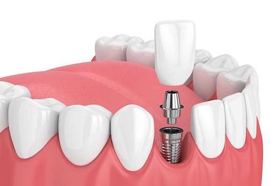 Is It Time for Dental Implants? 5 Key Signs to Look Out For