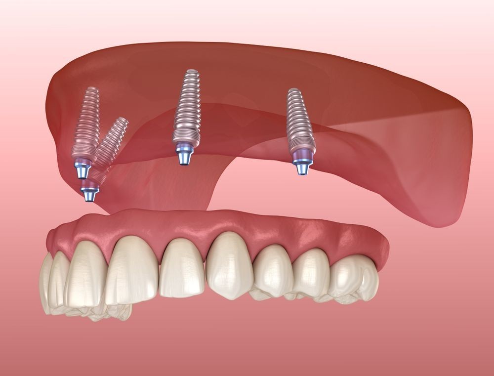 A Step-by-Step Guide to the All-on-4 Dental Implant Procedure