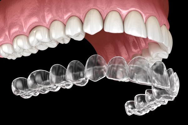 How Better Invisalign Are Compared to Braces?