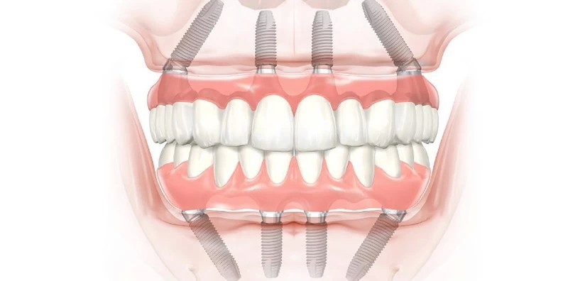 How Do All-on-4 Dental Implants Work?