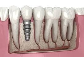 How Long Do Dental Implants Take to Settle Down?