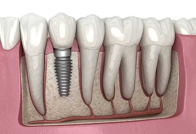 How Dental Implants Work and Why They Are a Game Changer