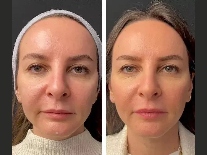 Mesotherapy Treatment in Dubai for Uneven Skin Tone
